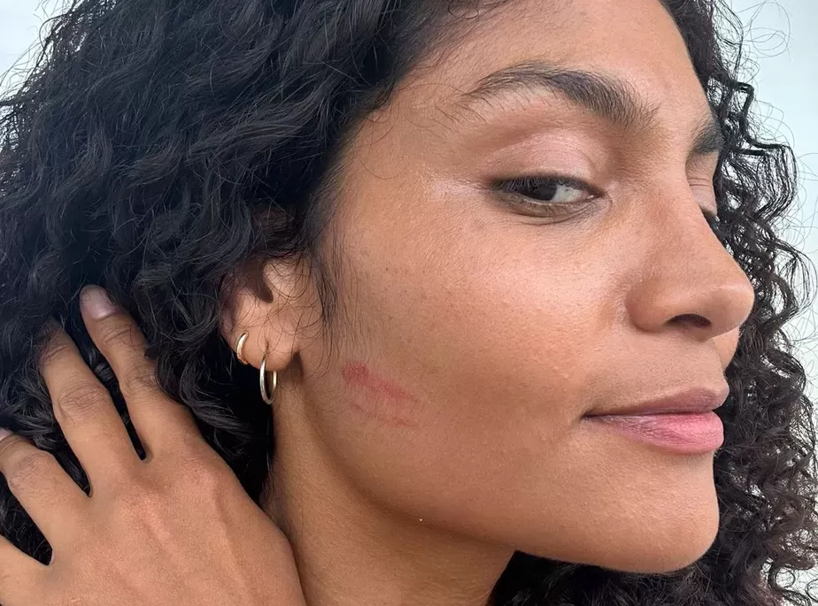 Barbara Reis exibe marca do beijo que ganhou de Susana Vieira: ‘Perdi a fala’