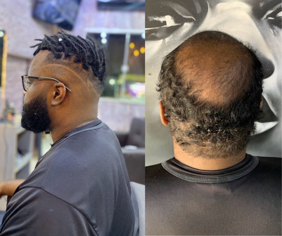 Transformando Vidas: A Incrível Técnica dos Baldlocs