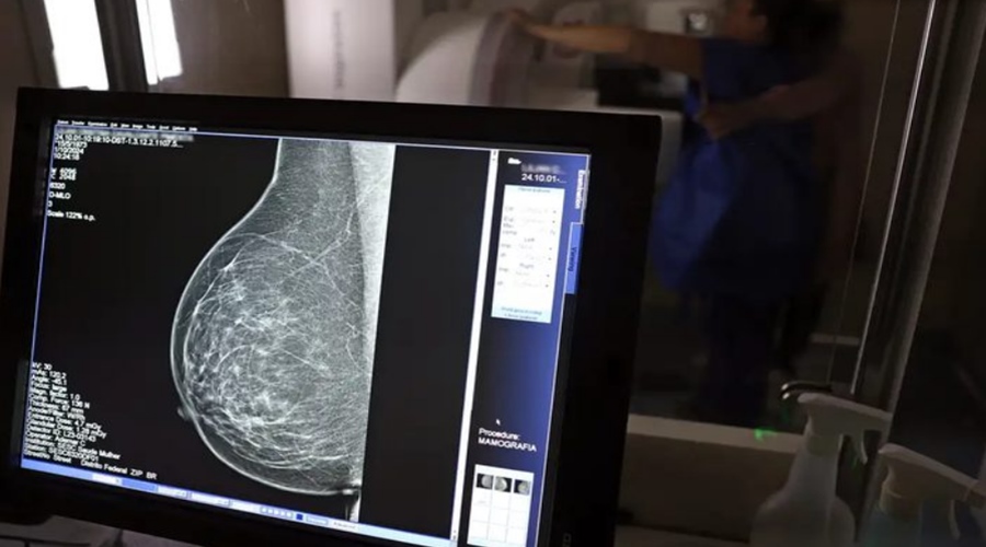 INCA alerta sobre câncer de mama agressivo e tardio em mulheres negras
